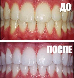 Отбеливание зубов
