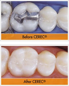 Фарфоровые пломбы CEREC